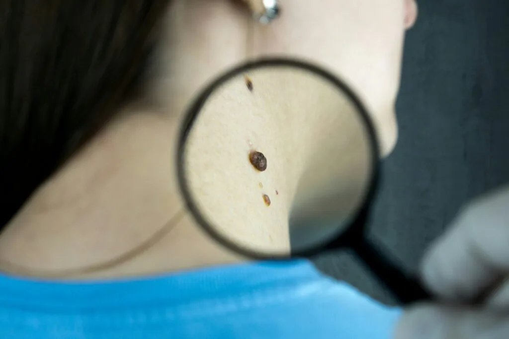 melanoma-vaccine-reduc-1024x683.jpg