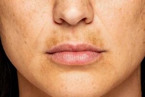 کدام غذاها باعث لک صورت می شوند؟