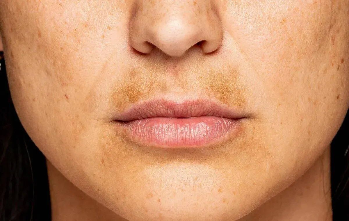 کدام غذاها باعث لک صورت می شوند؟