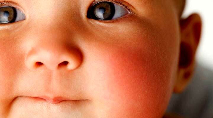 علت گل انداختن و سرخ شدن گونه ها چیست؟