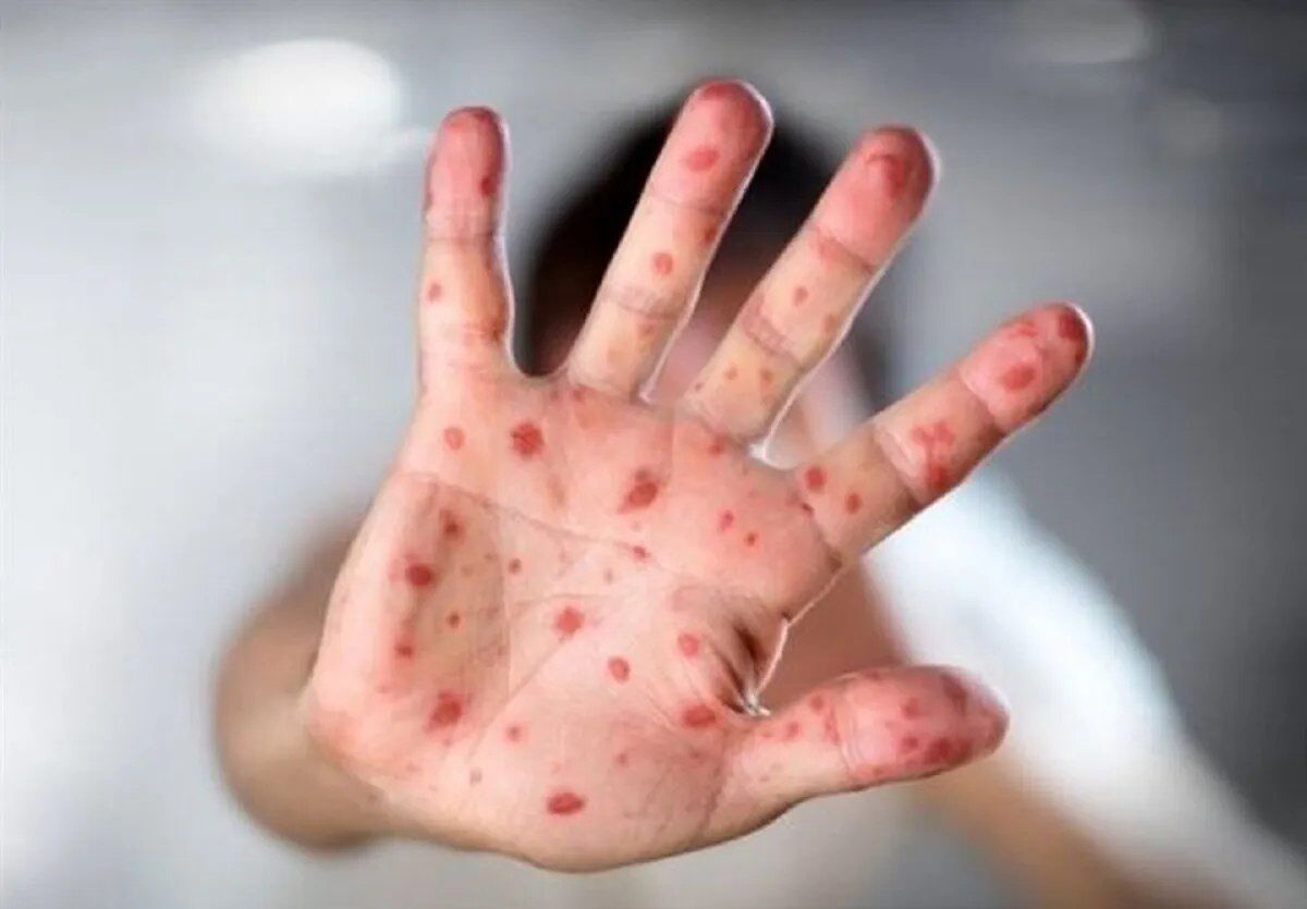 شیوع سرخک منجر به مسمومیت خطرناک ویتامین A می‌شود