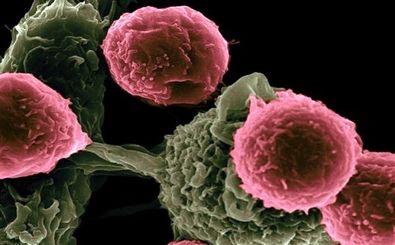 شایع‌ترین سرطان‌های زنان و مردان کدامند؟