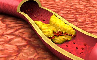 اگر این ۷ نشانه را دارید، ممکن است رگ‌های قلبتان مسدود شده باشند