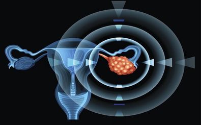تمرینات هوازی، یاری‌گر بدن زنان در برابر «سندرم تخمدان پلی‌کیستیک»