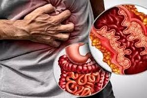 رژیم غذایی که علائم گوارشی در بیماران مبتلا به کرون را درمان می‌کند 