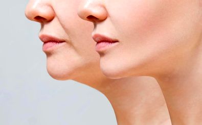 ویتامینی که کمبود آن باعث لاغری صورت می شود