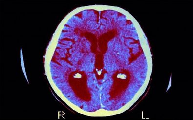 فراموشی زودهنگام در کودکان؛ یک دلیل خطرناک 