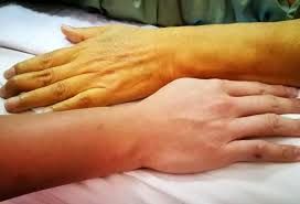 آیا زردی پوست می تواند نشانه ای از یرقان باشد؟