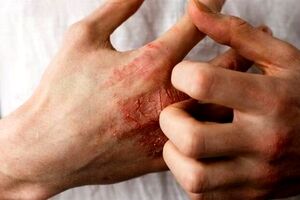 توصیه‌هایی درباره یک عارضه پوستیِ شایع