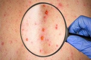 نقش موثر اپیدمیولوژی میدانی در کنترل سرخک و جلوگیری از گسترش آئدس 