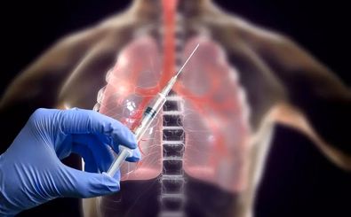 دانشمندان ایرانی واکسن سرطان ریه را ساختند/ ویدئو