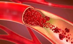 کاهش چشمگیر چربی خون با یک داروی جدید