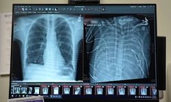 مردی که ۴۸ ساعت بدون ریه زنده ماند