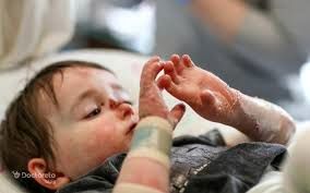 بیماری پروانه ای نتیجه جهش ژن در ازدواج های فامیلی است 