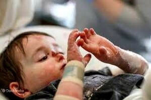 بیماری پروانه ای نتیجه جهش ژن در ازدواج های فامیلی است 