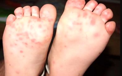 آیا تب برفکی به انسان منتقل می‌شود؟