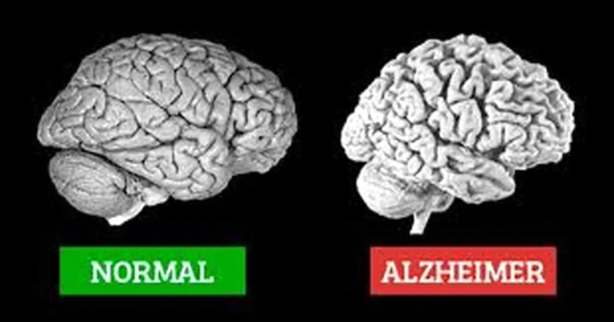 آلزایمر چیست، نشانه هایش کدام است و چه کنیم مبتلا نشویم؟ 