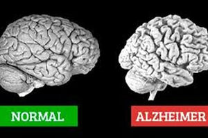 آلزایمر چیست، نشانه هایش کدام است و چه کنیم مبتلا نشویم؟ 