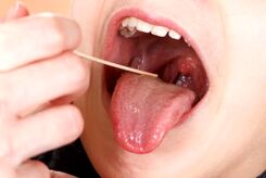 نقش لوزه‌ها در سیستم ایمنی بدن