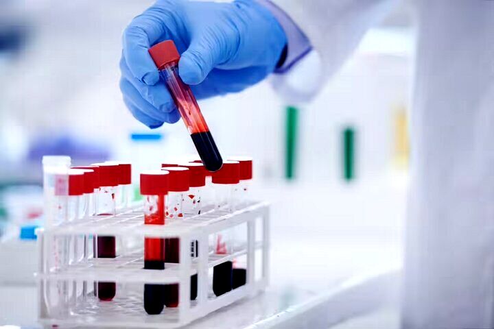تشخیص خستگی مزمن با یک آزمایش خون پیشرفته