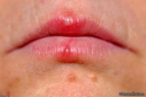 اشتباه مهلک در تشخیص آفت و تب‌خال؛ کدام‌یک مسری و خطرناک است؟