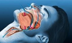 موفقیت ۹۳ درصدی درمان جدید آپنه خواب