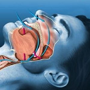 موفقیت ۹۳ درصدی درمان جدید آپنه خواب