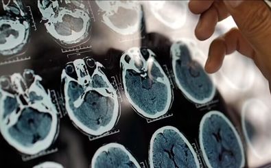 هر ۷ دقیقه یک ایرانی به این بیماری مبتلا می‌شود