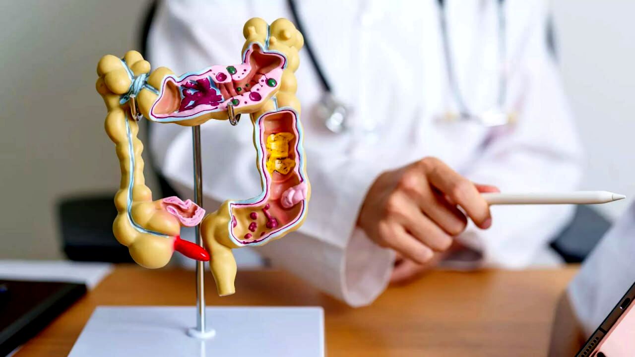 نتایج یک پژوهش جدید؛ افراد مبتلا به سرطان روده چگونه می‌توانند مانند افراد عادی عمر کنند؟
